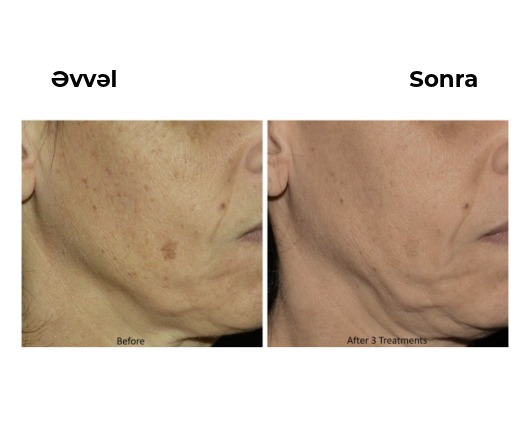 Lutronic LaseMD Ultra